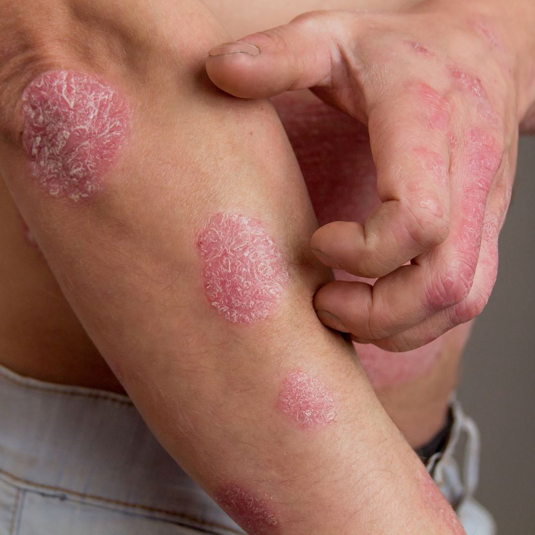 牛皮癬的中醫治療方案