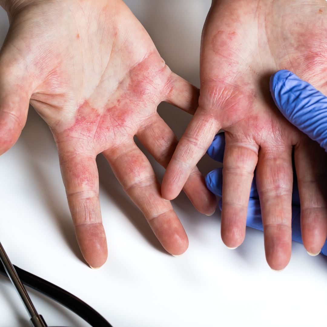 異位性皮炎的中醫治療解析