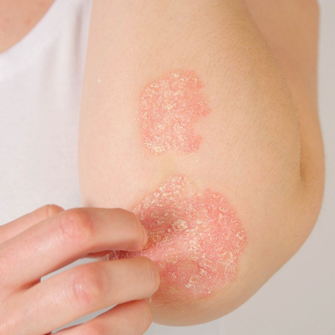 濕疹的中醫治療之道